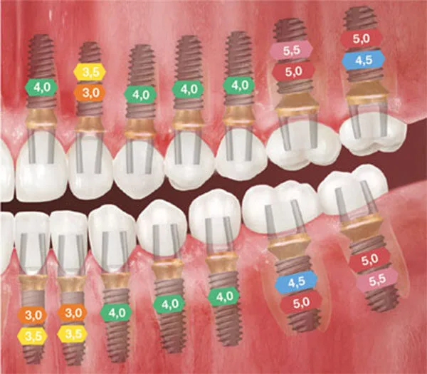 Recommended TS implant diameters by tooth position, with colour coding