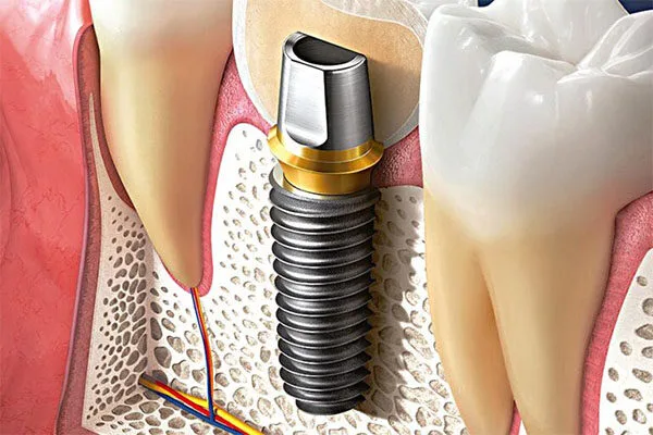 TS III SA implant placed at bone level